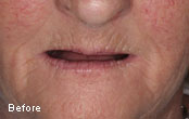 Cosmetic Dentures Before After 
